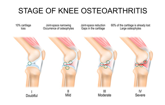 Understanding Osteoarthritis: Causes, Symptoms, and Treatment Options